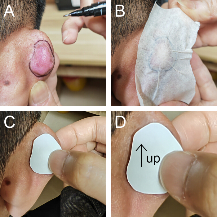 figure-results-4 Cyst removal process diagram, showing steps with tools, application, and patch placement.