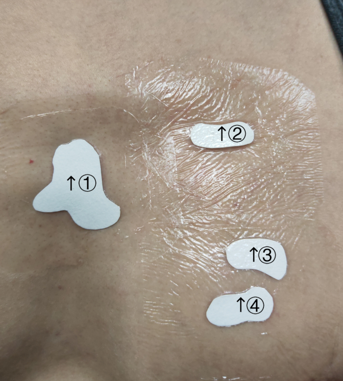 figure-results-9 Transdermal patch skin adhesion test, diagram with labeled adhesive samples, dermatological study.