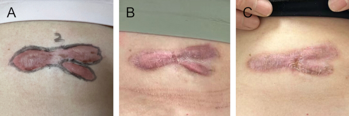 figure-results-10 Scar formation stages, clinical trial result, wound healing process, patient skin recovery.