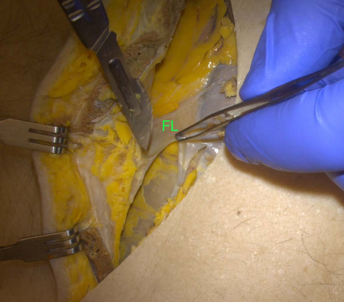 figure-results-1 Anatomy dissection process; fascia lata identified; labeled dissection display; educational use.