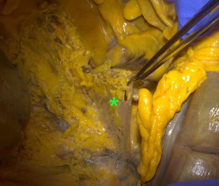 figure-results-3 Anatomy dissection, forceps revealing fatty tissue layers, human body study.