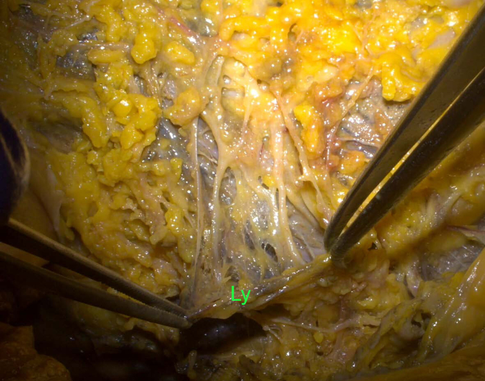 figure-results-4 Dissection displaying lymphatic structures and surrounding tissue, labeled "Ly."