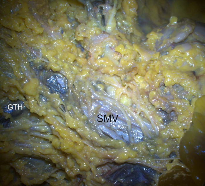 figure-results-8 Human anatomy dissection showing SMV and GTH; detailed vascular structure; educational diagram.