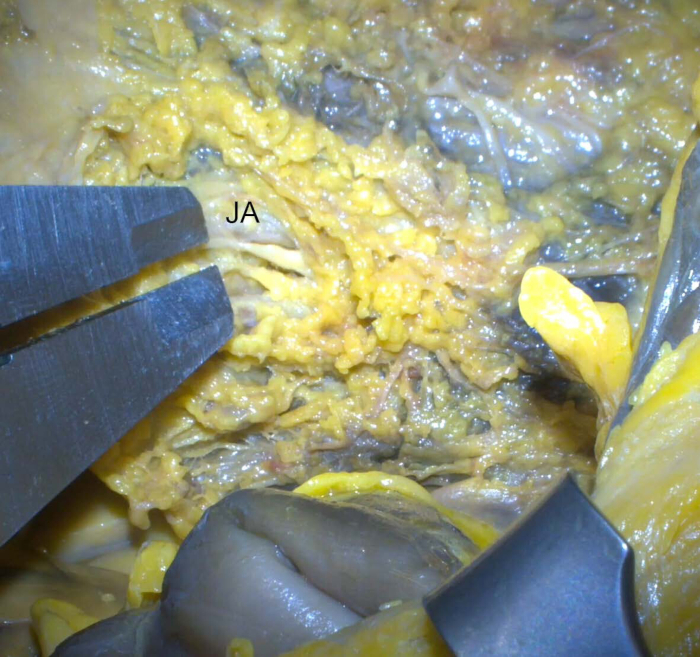 figure-results-9 Surgical dissection of yellow fat tissue, labeled "JA," with forceps, anatomical study.