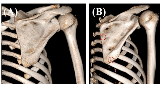figure-results-2 Shoulder bone 3D scan comparison; normal (A) vs abnormal (B) with lesions marked.