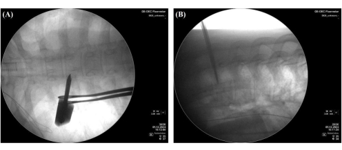 figure-results-3 Fluoroscopy imaging; spinal biopsy procedure; monitoring; radiological examination; clinical method.