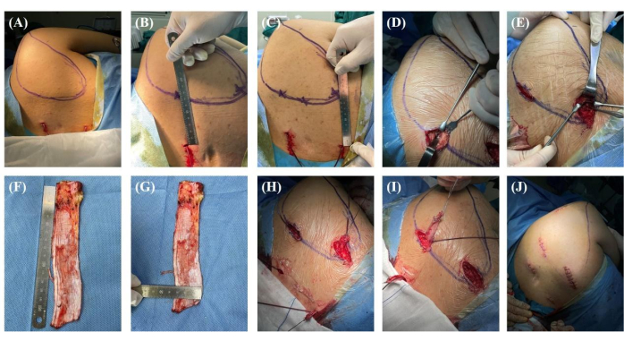 figure-results-4 Surgical process images showing shoulder incision, graft preparation, and post-operative sutures.
