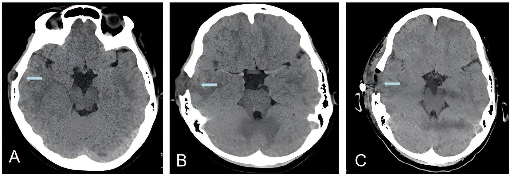 Aggressive Langerhans Cell Histiocytosis (LCH) of Right Temporal Bone