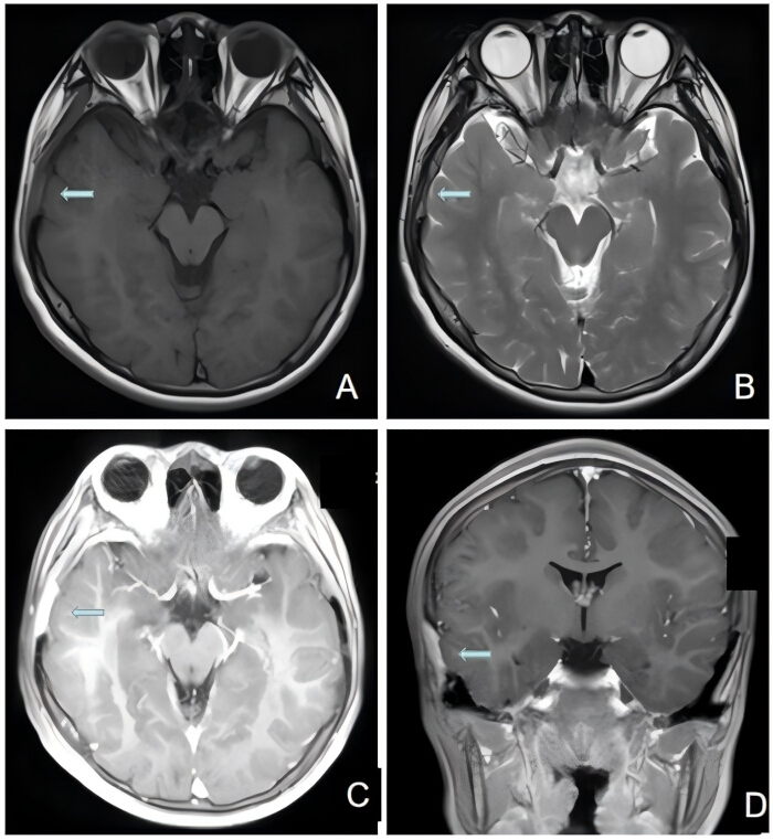 Aggressive Langerhans Cell Histiocytosis (LCH) of Right Temporal Bone