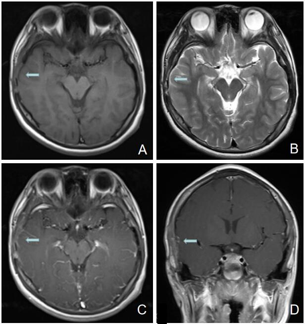 Aggressive Langerhans Cell Histiocytosis (LCH) of Right Temporal Bone