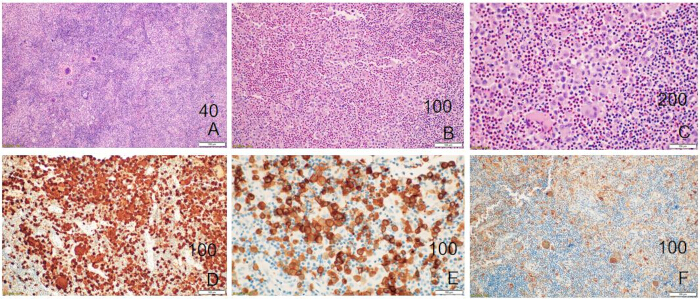 Aggressive Langerhans Cell Histiocytosis (LCH) of Right Temporal Bone