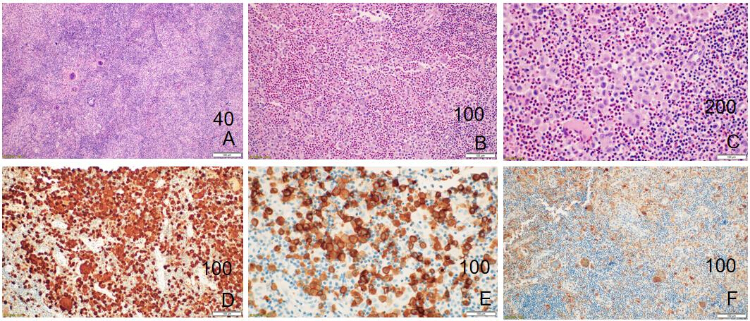 Aggressive Langerhans Cell Histiocytosis (LCH) of Right Temporal Bone