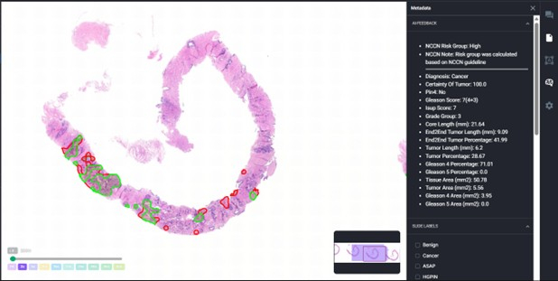 figure-results-6 Pathology slide analysis, histopathological diagram, cancer diagnosis, Gleason score assessment.