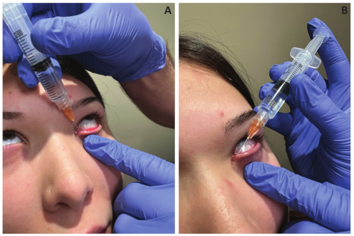 Ocular injection procedure, demonstrating intravitreal injection technique with syringe close-up.