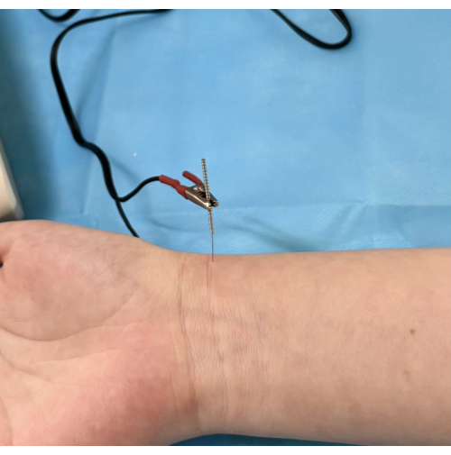 figure-results-3 Acupuncture needle and electrode for neurostimulation therapy on forearm, close-up.