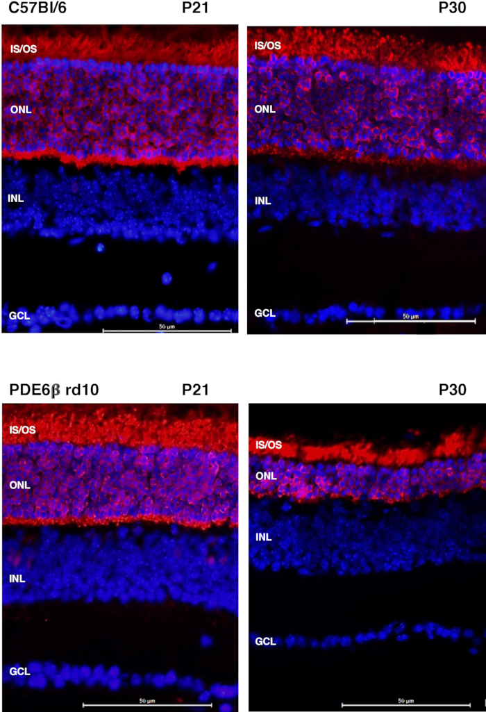 Retisite Tab Retinite Pigmentosa Antes E Depois