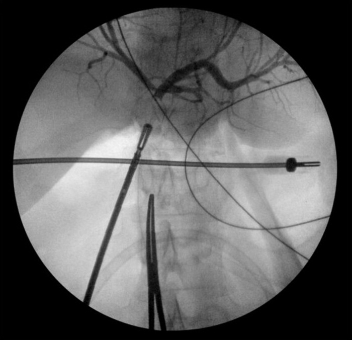 Interventional radiology process, angiography diagram, catheter placement in arterial system.
