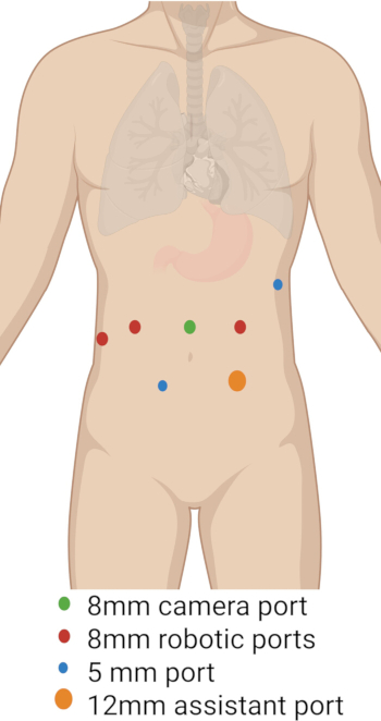 Trocar port placement diagram with camera and robotic ports for abdominal surgery setup.