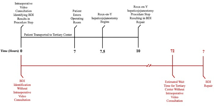 Timeline diagram of BDI procedure with video consultation; Roux-en-Y hepaticojejunal surgery steps.