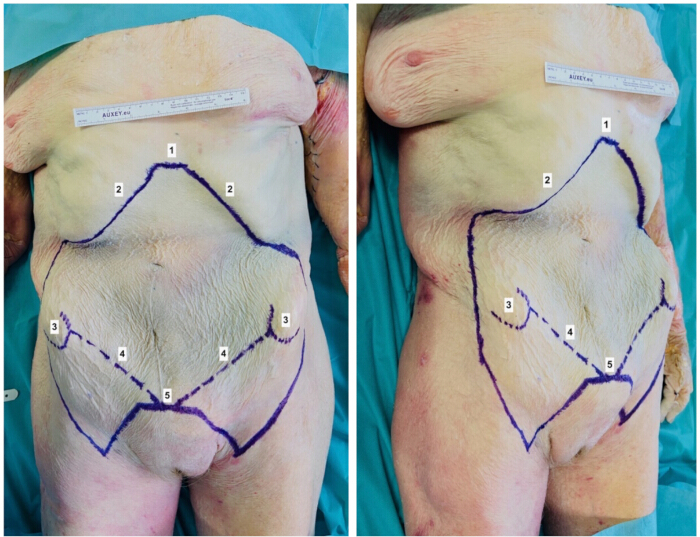 figure-protocol-1 Surgical planning diagram for abdominal skin flap markings, highlighting incision paths and regions.