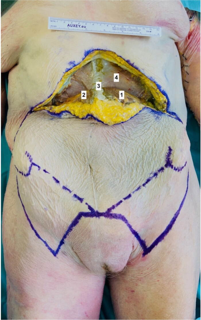 figure-protocol-2 Abdominal anatomy dissection, surgical exploration showing tissue layers, medical education reference.