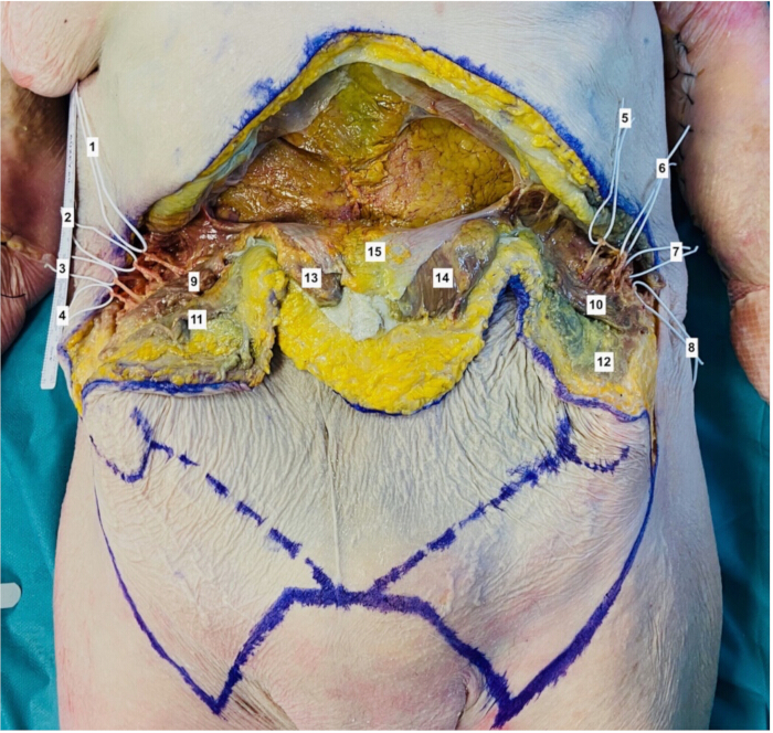 figure-protocol-3 Abdominal anatomy dissection showing muscle layers in a surgical procedure, labeled for study.