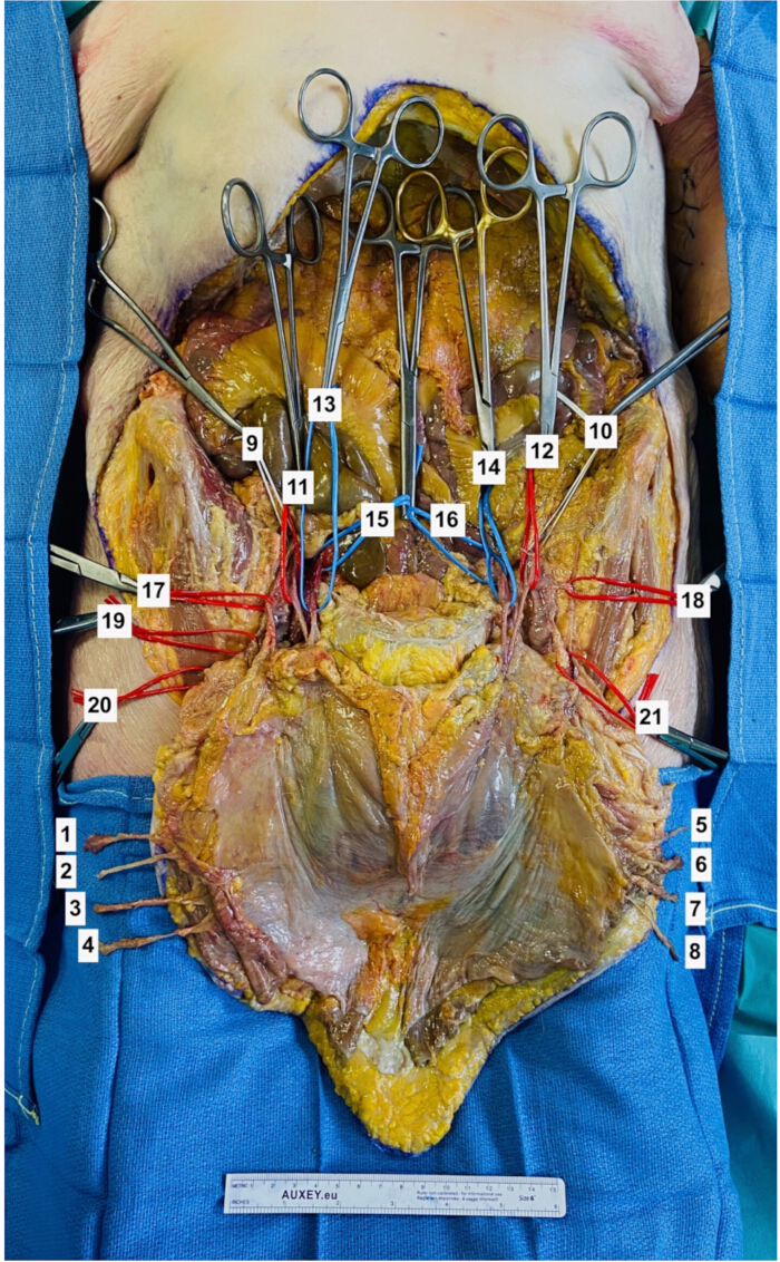 figure-protocol-4 Human anatomy dissection, abdominal cavity, labeled structures, surgical clamps, educational study.