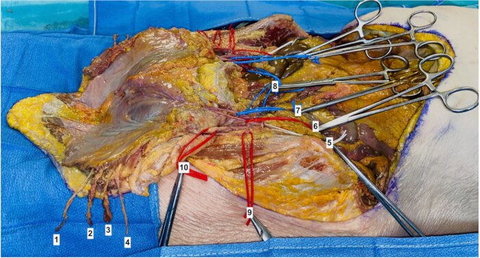 figure-protocol-5 Surgical dissection; labeled tissue structures, showcasing anatomical exploration, medical study.