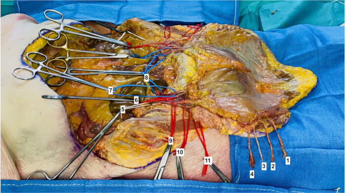 figure-protocol-6 Surgical anatomy dissection with labeled structures, displaying tissue layers and surgical tools.