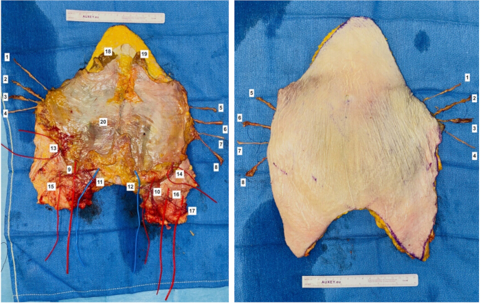 figure-protocol-7 Surgical anatomy dissection diagram, highlighting numbered muscle and nerve structures for study.