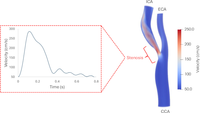 figure-results-2 Blood flow velocity analysis; graph and stenosis diagram, arterial narrowing impact study.