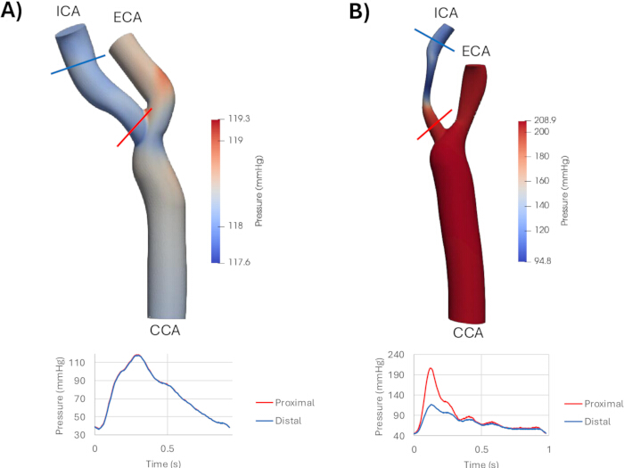 figure-results-3 Blood flow simulation; pressure variation in carotid arteries; diagram and graphs; hemodynamics analysis.