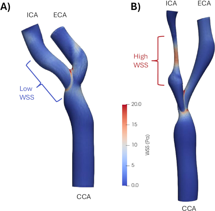 figure-results-4 Carotid artery wall shear stress (WSS) simulation; diagram for vascular analysis, low/high WSS areas.