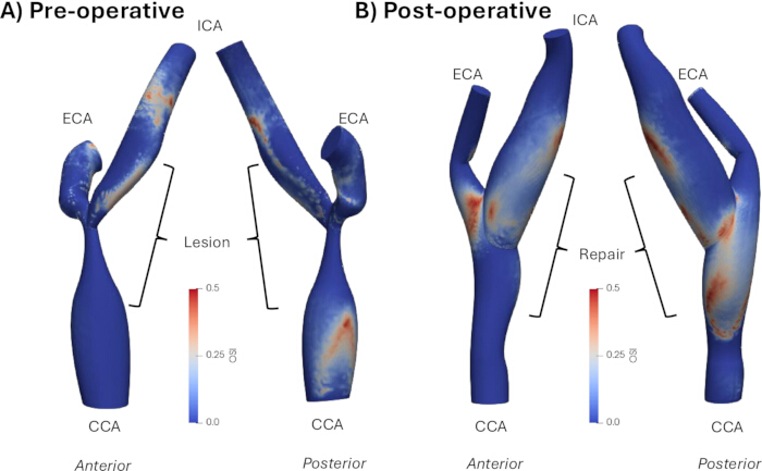 figure-results-5 Carotid artery stenosis simulation, pre- and post-operative models, lesion repair analysis diagram.