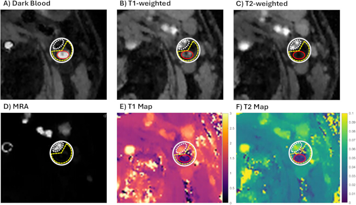 figure-results-6 Cardiac MRI: Dark blood, T1/T2-weighted images, MRA, T1/T2 maps; analysis of heart structure.