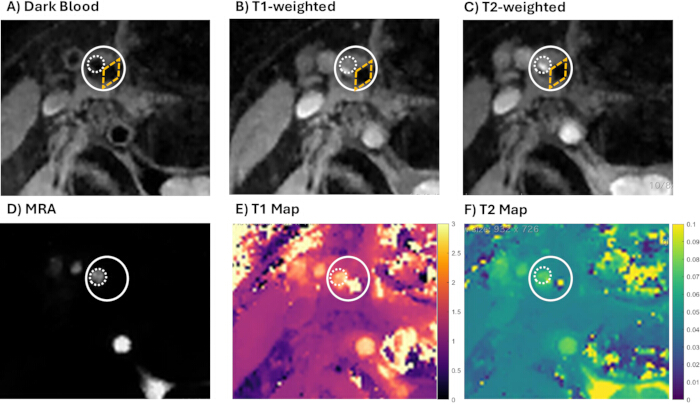 figure-results-7 MRI differentials: dark blood, T1, T2, MRA, T1 and T2 maps highlighting heart structures.