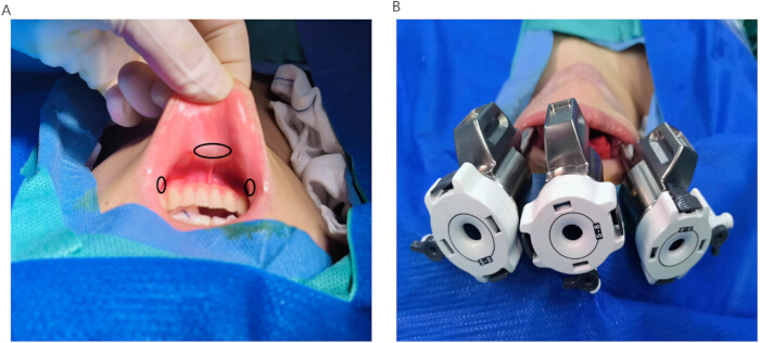 figure-results-2 Oral surgery procedure, surgical guide placement, dental implant setup, clinical technique diagram.
