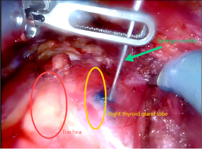 figure-results-3 Thyroid biopsy procedure; syringe needle near right thyroid gland lobe; trachea identified.