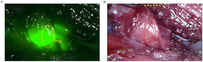 figure-results-4 Fluorescence imaging of parathyroid gland (PTG) in surgical procedure; left: green fluorescence.