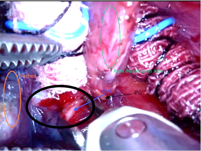 figure-results-6 Surgical anatomy of thyroid and trachea; RLN identification; intraoperative procedure image.