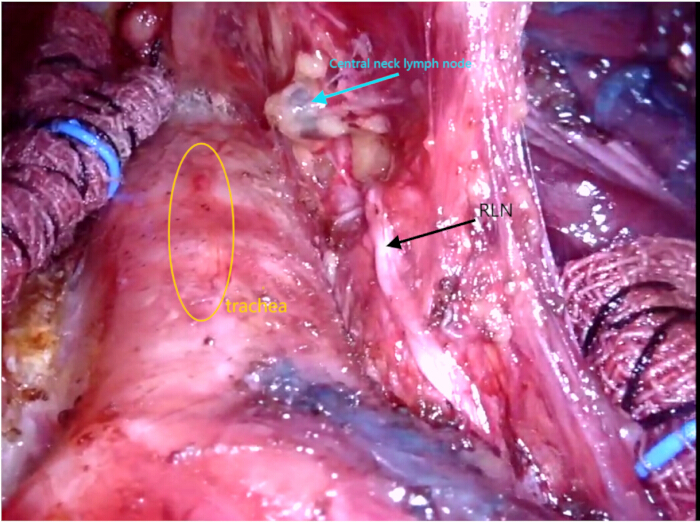figure-results-7 Surgical anatomy, trachea, lymph node dissection, labeled diagram, central neck, RIN identification.