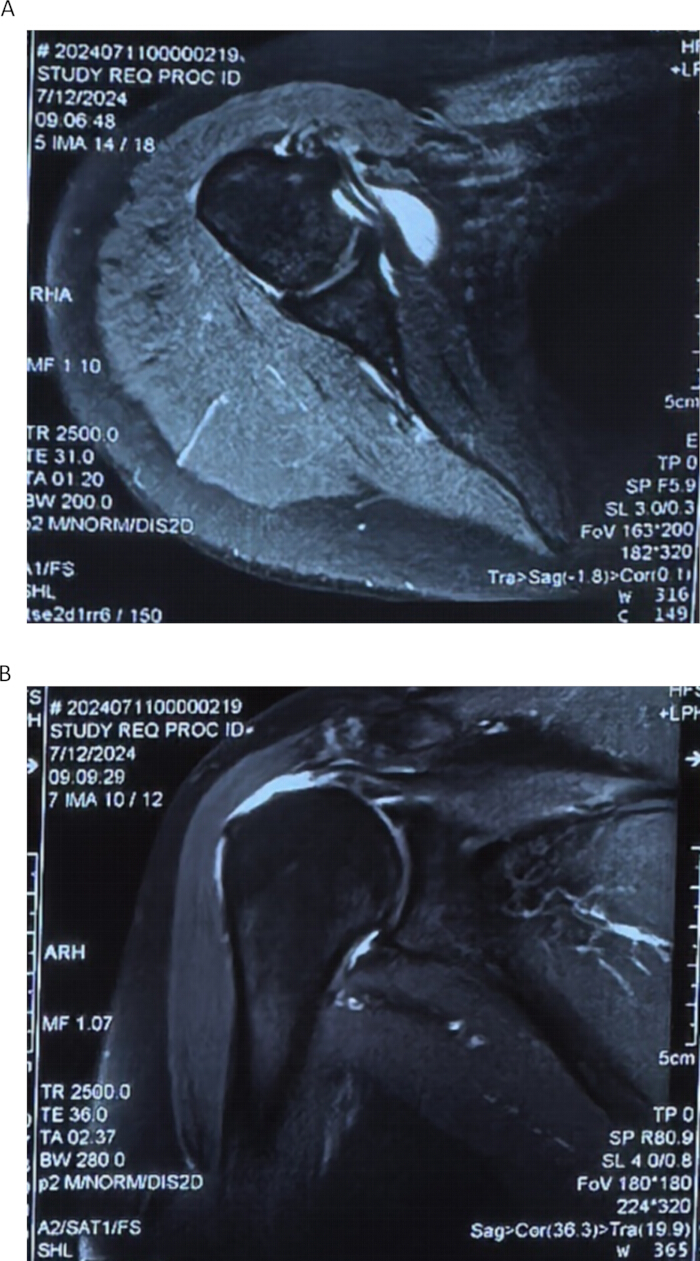 figure-results-1 MRI scans of shoulder joint, coronal view; diagnostic imaging, joint evaluation, clinical assessment.