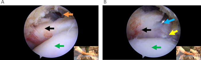 figure-results-2 Arthroscopic knee surgery diagram, showing cartilage repair techniques with arrows indicating areas.