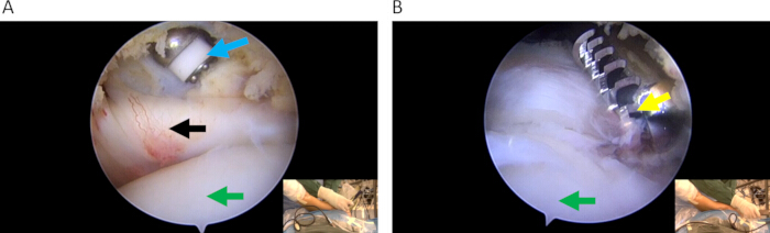 figure-results-3 Arthroscopic surgery procedure, internal knee view, tool insertion, ligament repair, medical imaging.