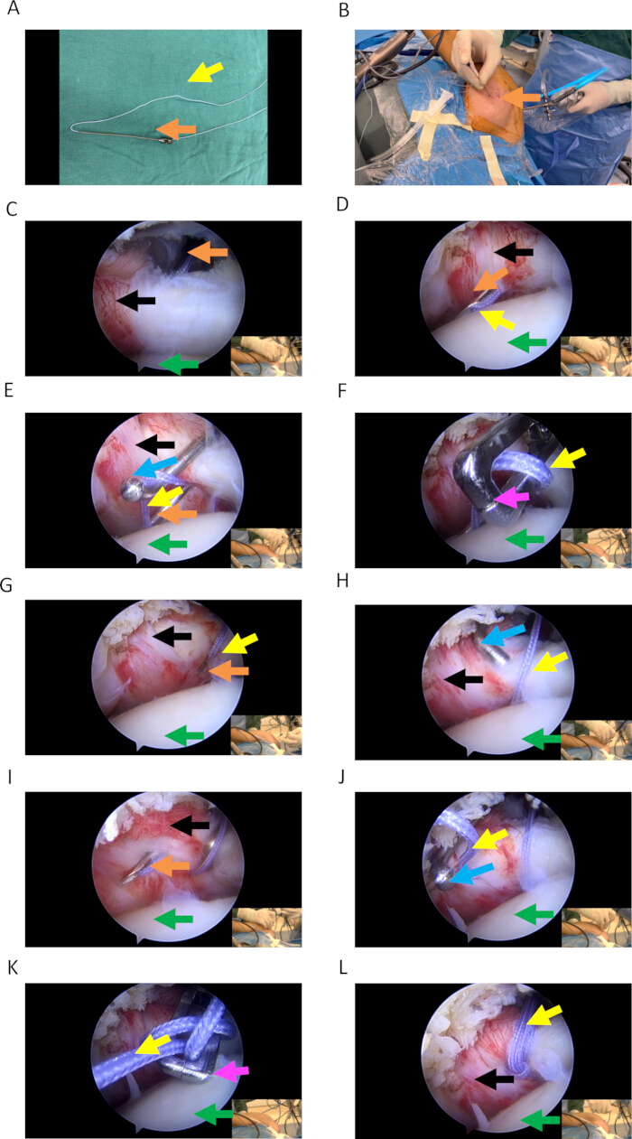 figure-results-4 Surgical procedure diagrams; arthroscopy setup; rotator cuff repair steps with visual indicators.