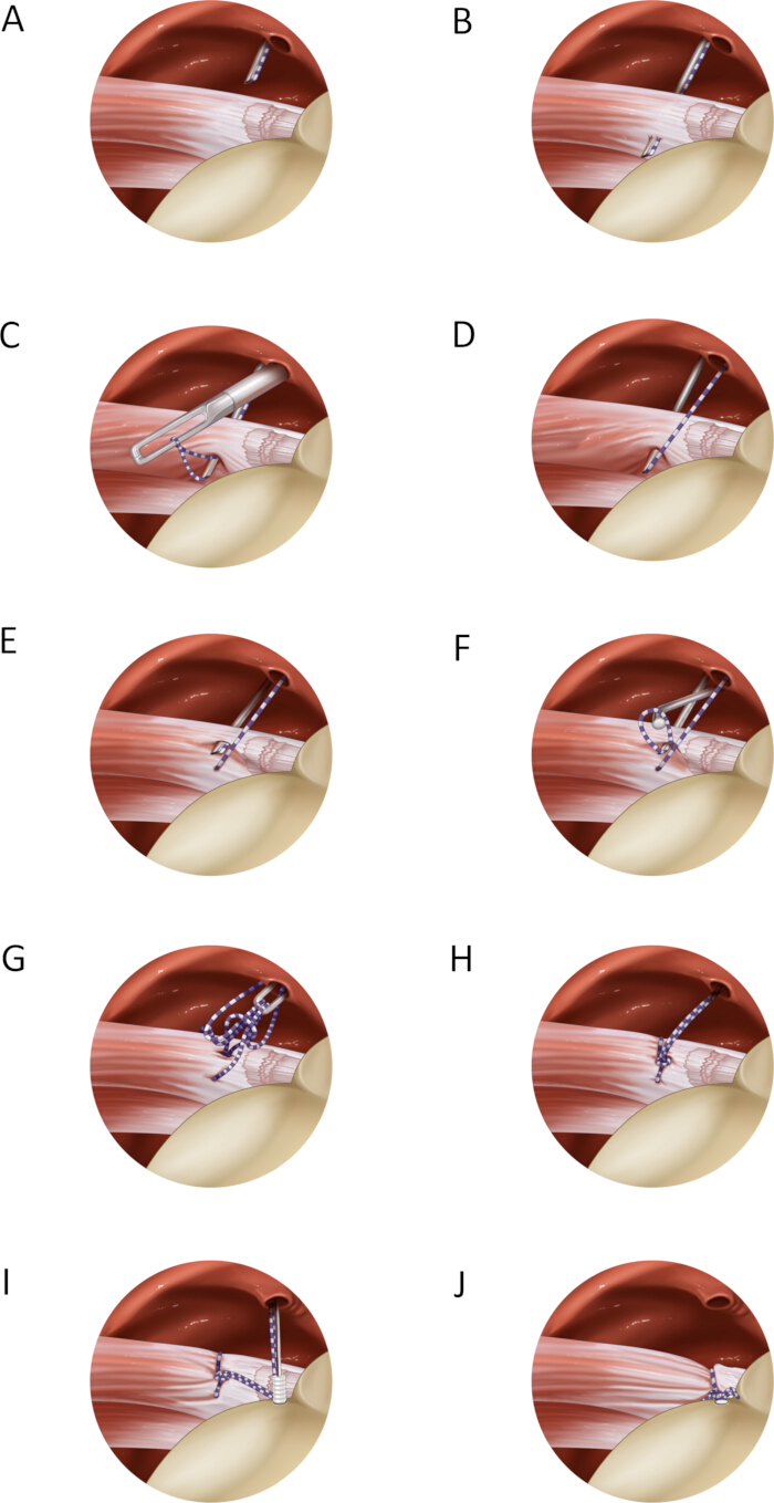 figure-results-5 ACL repair surgical process using knots and sutures; medical illustration sequence.