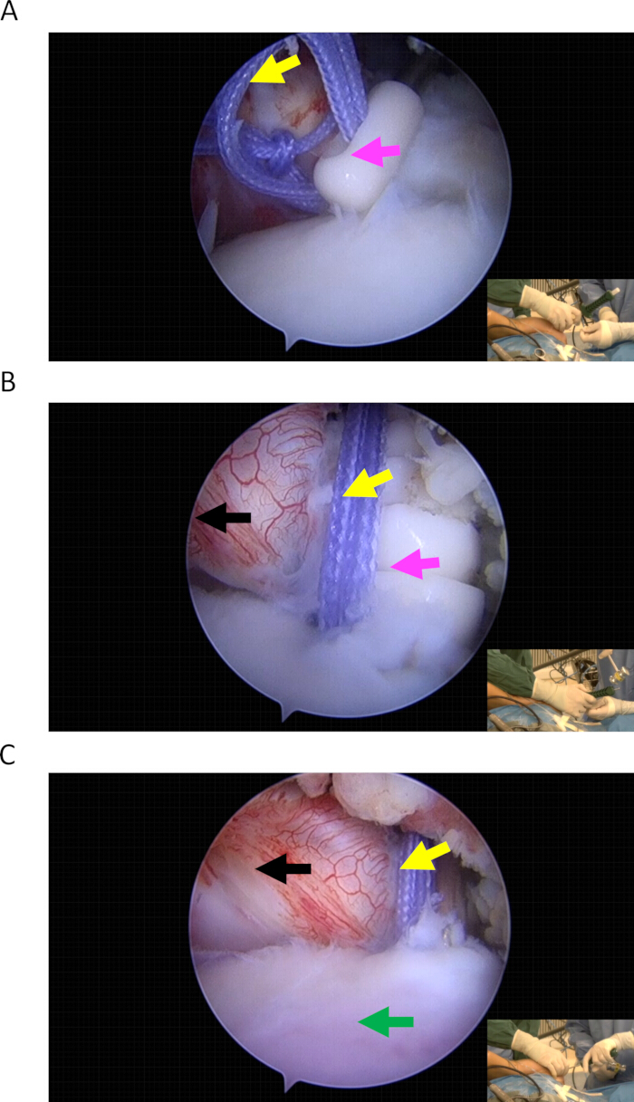 figure-results-6 Arthroscopic surgery steps; ligament repair; labeled diagram.