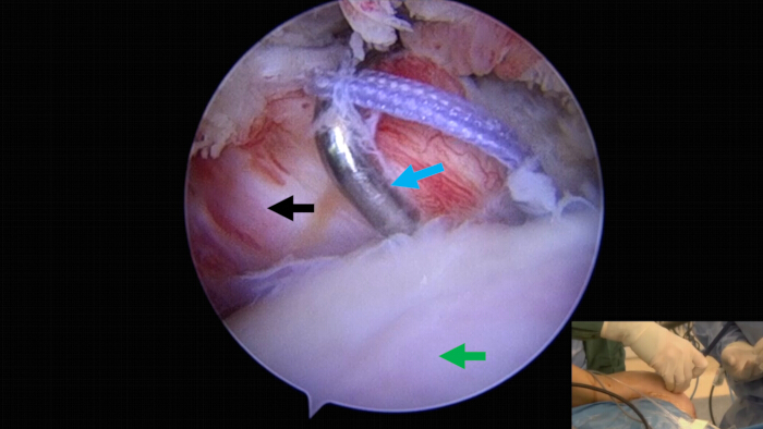 figure-results-7 Arthroscopic knee surgery, suturing technique demonstration, medical procedure, orthopedic repair.