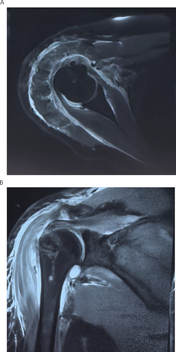 figure-results-8 MRI shoulder scan; A: axial view; B: sagittal view; diagnostic imaging; musculoskeletal assessment.