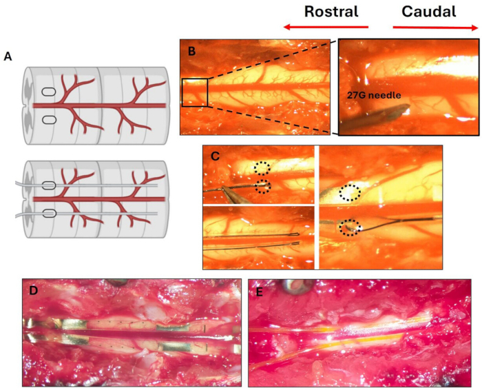 Spinal cord surgery diagram with needle insertion, vascular structures, procedural steps, rostral-caudal.